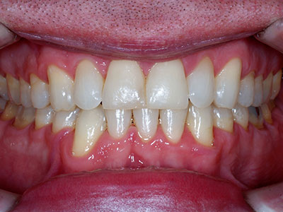 Cross-bite-After