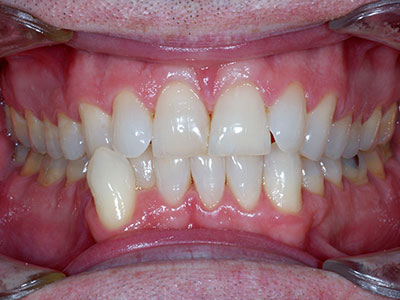 Cross-bite-Before