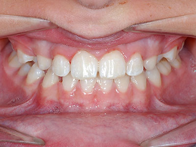 Underbite-After